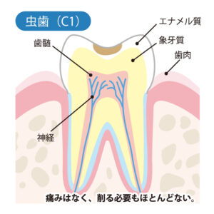 大府市(愛知県)の歯医者、斎藤歯科医院で虫歯の治療相場についての解説