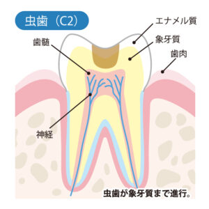 大府市(愛知県)の歯医者、斎藤歯科医院で虫歯の治療相場についての解説