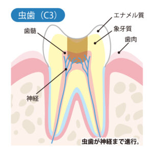 大府市(愛知県)の歯医者、斎藤歯科医院で虫歯の治療相場についての解説