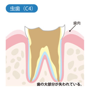 大府市(愛知県)の歯医者、斎藤歯科医院で虫歯の治療相場についての解説