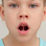 大府市（愛知県）の歯医者、斎藤歯科医院で舌小帯短縮症についての解説