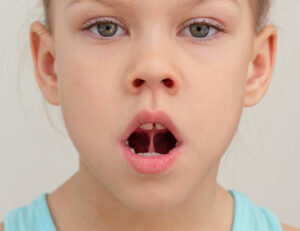 大府市（愛知県）の歯医者、斎藤歯科医院で舌小帯短縮症についての解説