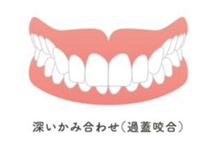 大府市（愛知県）の歯医者、斎藤歯科医院で舌小帯短縮症についての解説