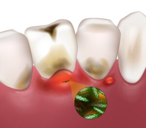 大府市（愛知県）の歯医者、斎藤歯科医院で口臭についての解説