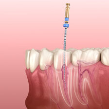 大府市（愛知県）の歯医者、斎藤歯科医院で歯の根っこの治療が長引く理由と治療期間を短縮するポイントを解説