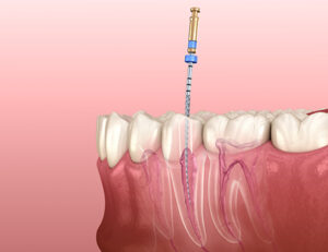 大府市（愛知県）の歯医者、斎藤歯科医院で歯の根っこの治療が長引く理由と治療期間を短縮するポイントを解説