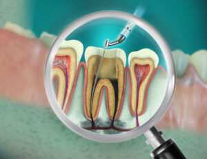 大府市（愛知県）の歯医者、斎藤歯科医院で歯の根っこの治療が長引く理由と治療期間を短縮するポイントを解説