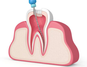 大府市（愛知県）の歯医者、斎藤歯科医院で歯の根っこの治療が長引く理由と治療期間を短縮するポイントを解説