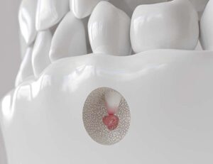 大府市（愛知県）の歯医者、斎藤歯科医院で歯の根っこの治療が長引く理由と治療期間を短縮するポイントを解説