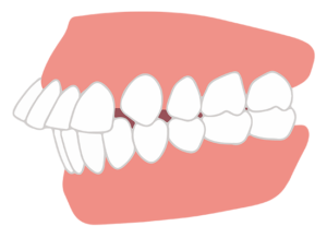 大府市（愛知県）の歯医者、斎藤歯科医院で子どもの指しゃぶりが歯並びに与える影響と卒業のサポート方法を解説