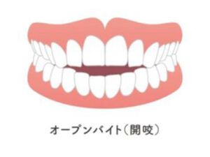 大府市（愛知県）の歯医者、斎藤歯科医院でなぜ無意識に舌で前歯を押すクセがつく？原因と対処法を解説