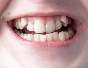 大府市（愛知県）の歯医者、斎藤歯科医院で、乳歯が”キレイ”は要注意？乳歯に隙間がない子が直面する『永久歯の渋滞』とは。を解説