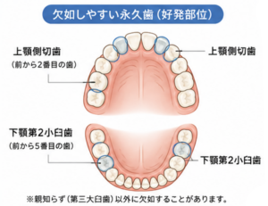 大府市（愛知県）の歯医者、斎藤歯科医院で『永久歯がない？』と診断されたら。先天性欠如の基礎知識と、治療の選択肢について解説