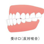 大府市（愛知県）の歯医者、斎藤歯科医院で「受け口（反対咬合）」を放置するとどうなる？考えられるリスクと早期治療のメリットを解説