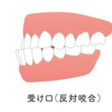 大府市（愛知県）の歯医者、斎藤歯科医院で「受け口（反対咬合）」を放置するとどうなる？考えられるリスクと早期治療のメリットを解説