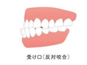 大府市（愛知県）の歯医者、斎藤歯科医院で「受け口（反対咬合）」を放置するとどうなる？考えられるリスクと早期治療のメリットを解説