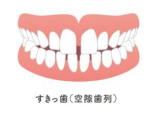 大府市（愛知県）の歯医者、さいとう歯科こども矯正歯科で子どもの「過剰歯」はいつ抜くべき？そのままにしておくデメリットと抜歯のタイミングを解説