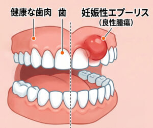 大府市（愛知県）の歯医者、さいとう歯科こども矯正歯科で妊娠性エプーリスとは？歯ぐきにできるしこりの原因と出産後の経過を解説