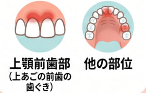大府市（愛知県）の歯医者、さいとう歯科こども矯正歯科で妊娠性エプーリスとは？歯ぐきにできるしこりの原因と出産後の経過を解説